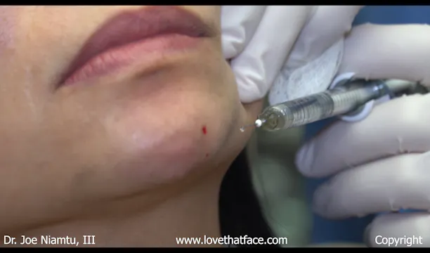 Fiiller Injection to Chin