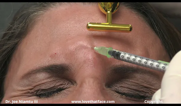 90 Units of Dysport to Glabella and Lateral Canthus