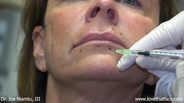 Botox to Lip Lines, Chin and DAO
