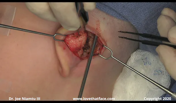 Case 2 Mustarde and Davis Otoplasty