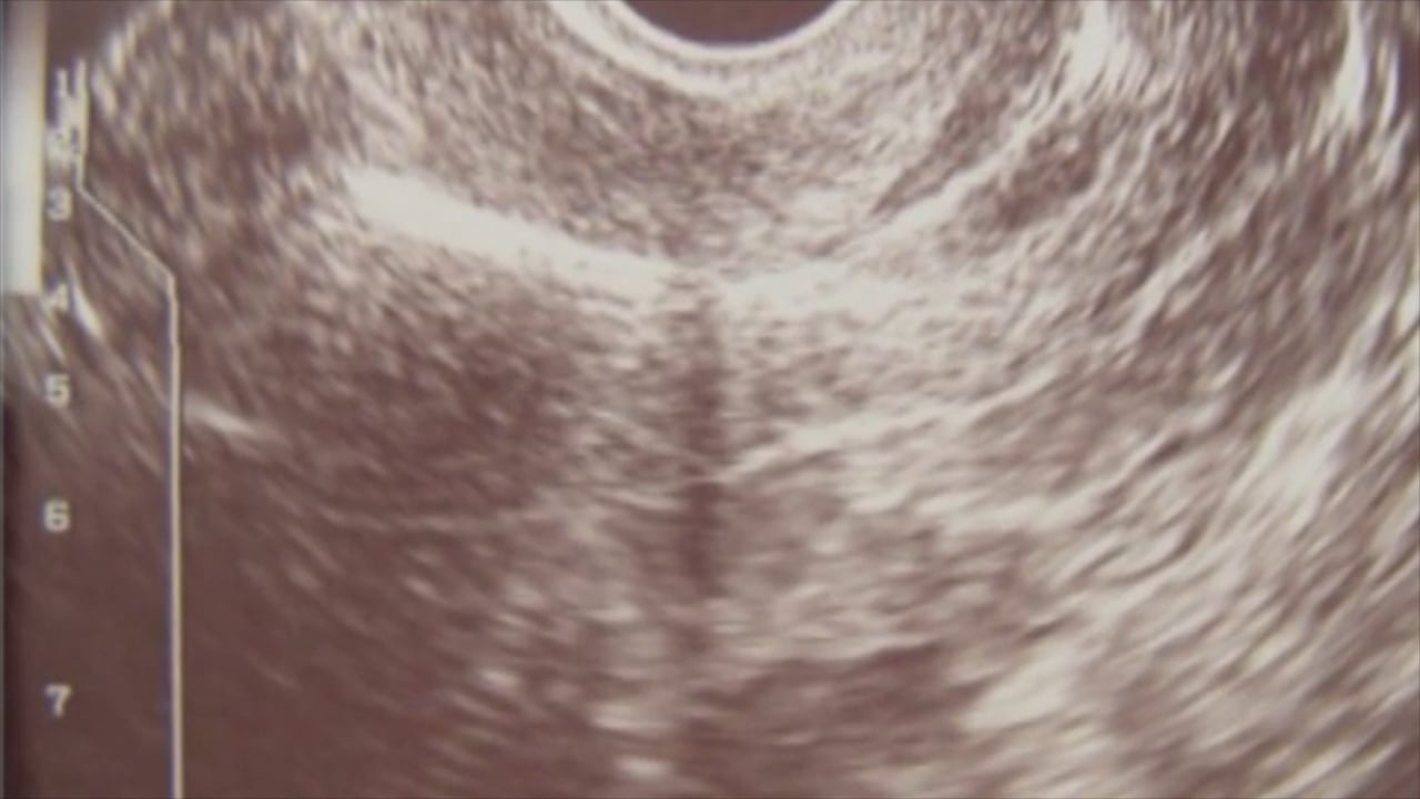 5 Minute IUD Insertion Commentary