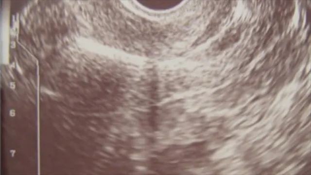 5 Minute IUD Insertion Commentary