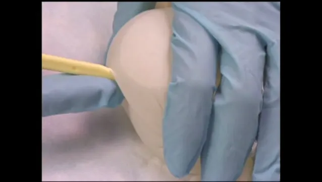 Amniotomy