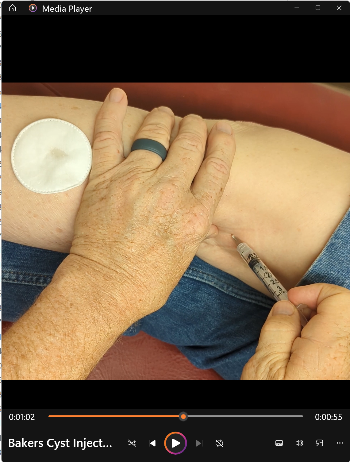 Bakers Cyst Injection, Dennis Harper, DC + Protocol