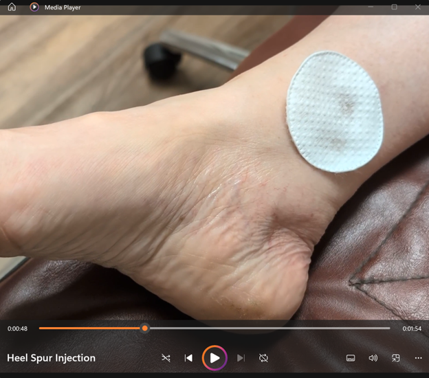Heel Spur Injection
