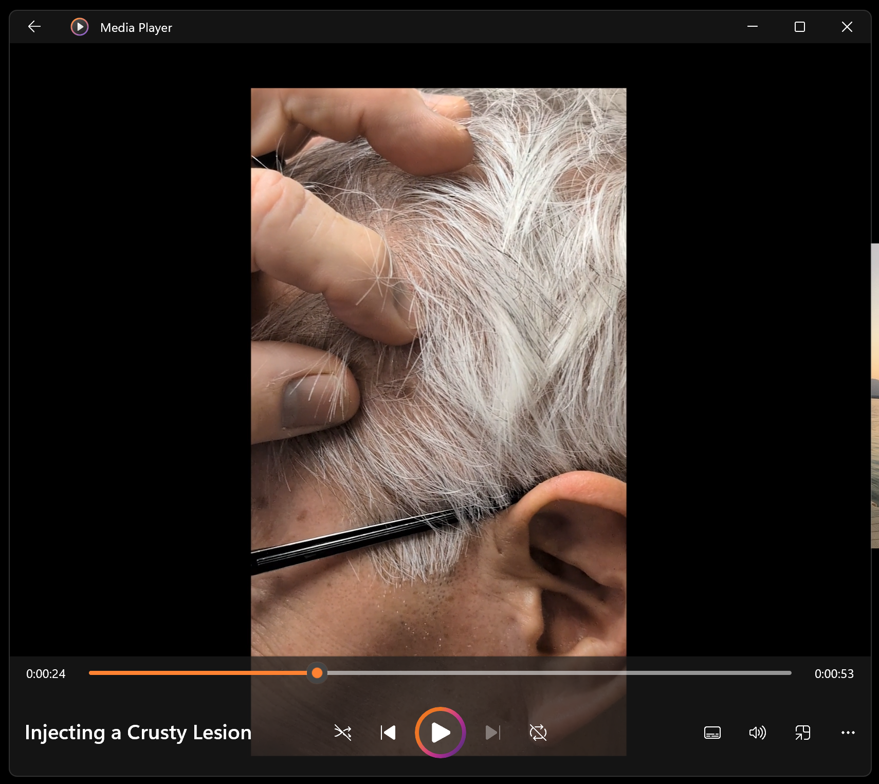 Injecting a Crusty Lesion