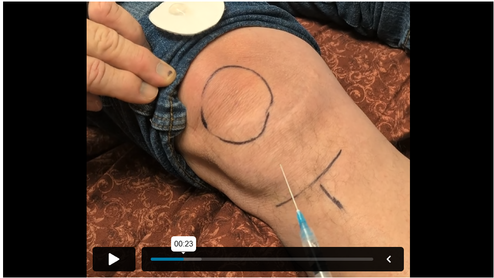 Subpatellar Knee Injection