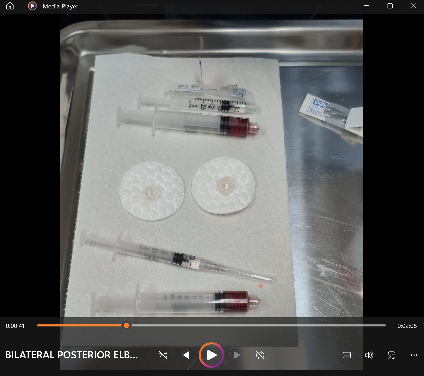 BILATERAL POSTERIOR ELBOW Injection - Final