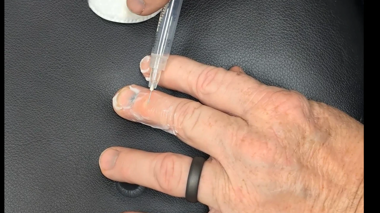 Heberden's Node Injection - OCBM Roadmap Virtual Video Training Library