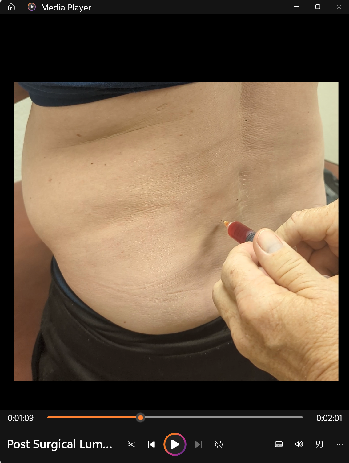 Post Surgical Lumbar Injection - Dennis Harper, DC