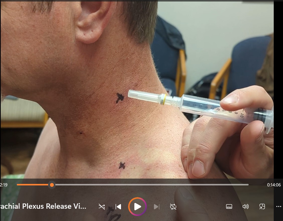 Brachial Plexus Release Injection