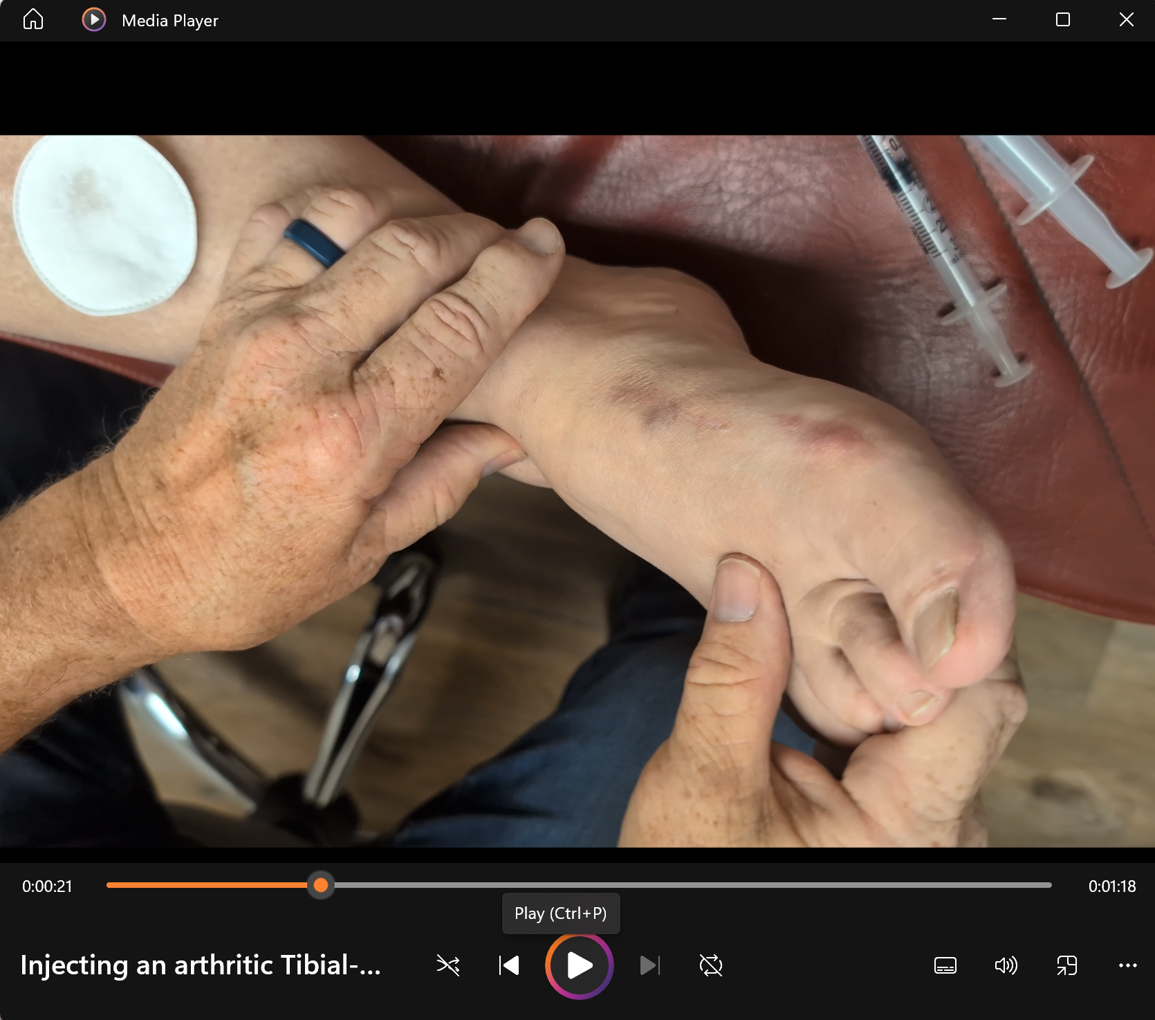 Injecting An Arthritic Tibial-Talar Joint - Dennis Harper