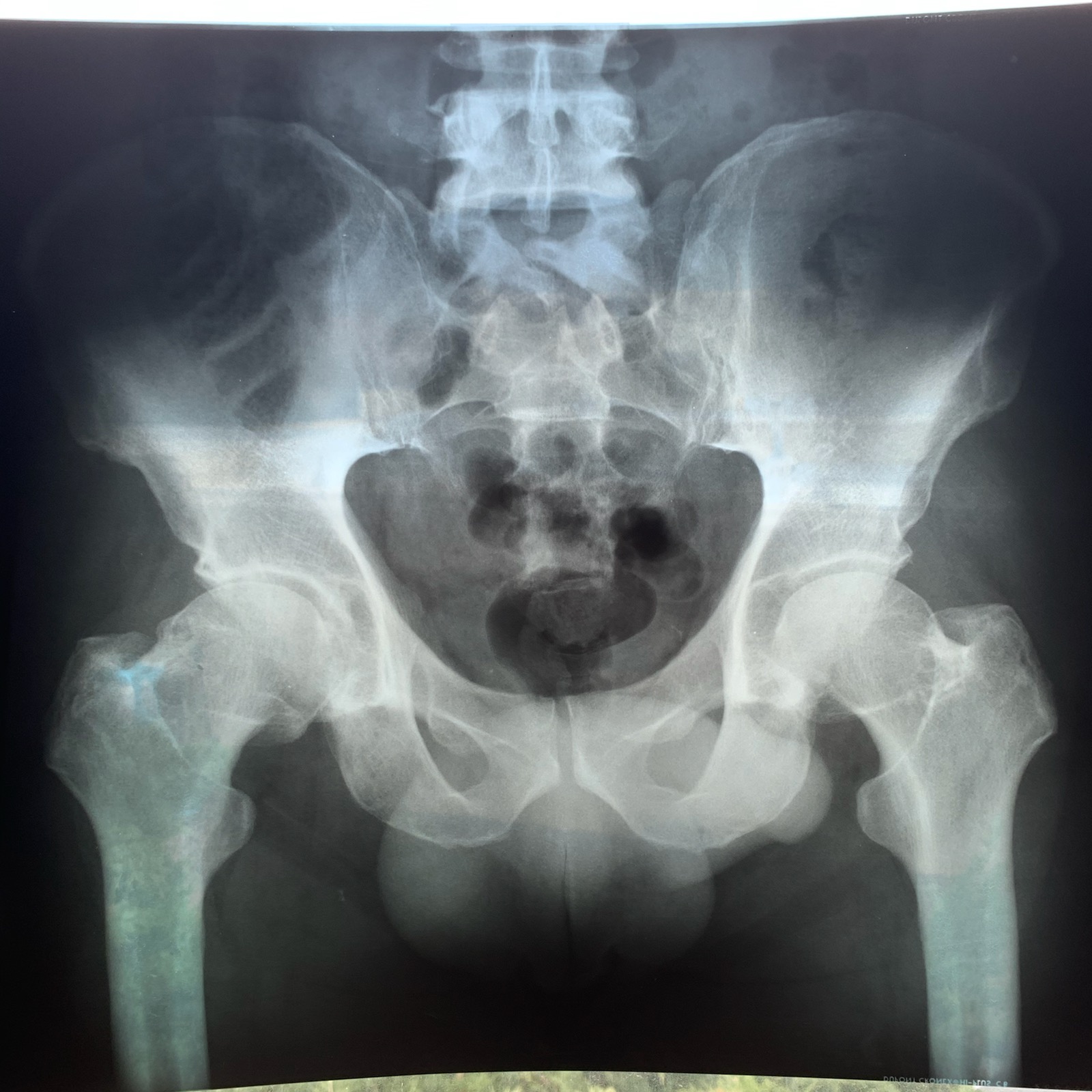 3-site-Hip-Injection---Exam-by-Dennis-Harper-DC-Hip-EXRAY.jpg