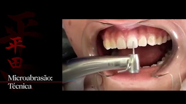 Microabrasion: Technique and Practica...