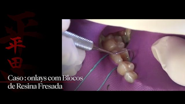 Case - Onlays with Milled Composite B...