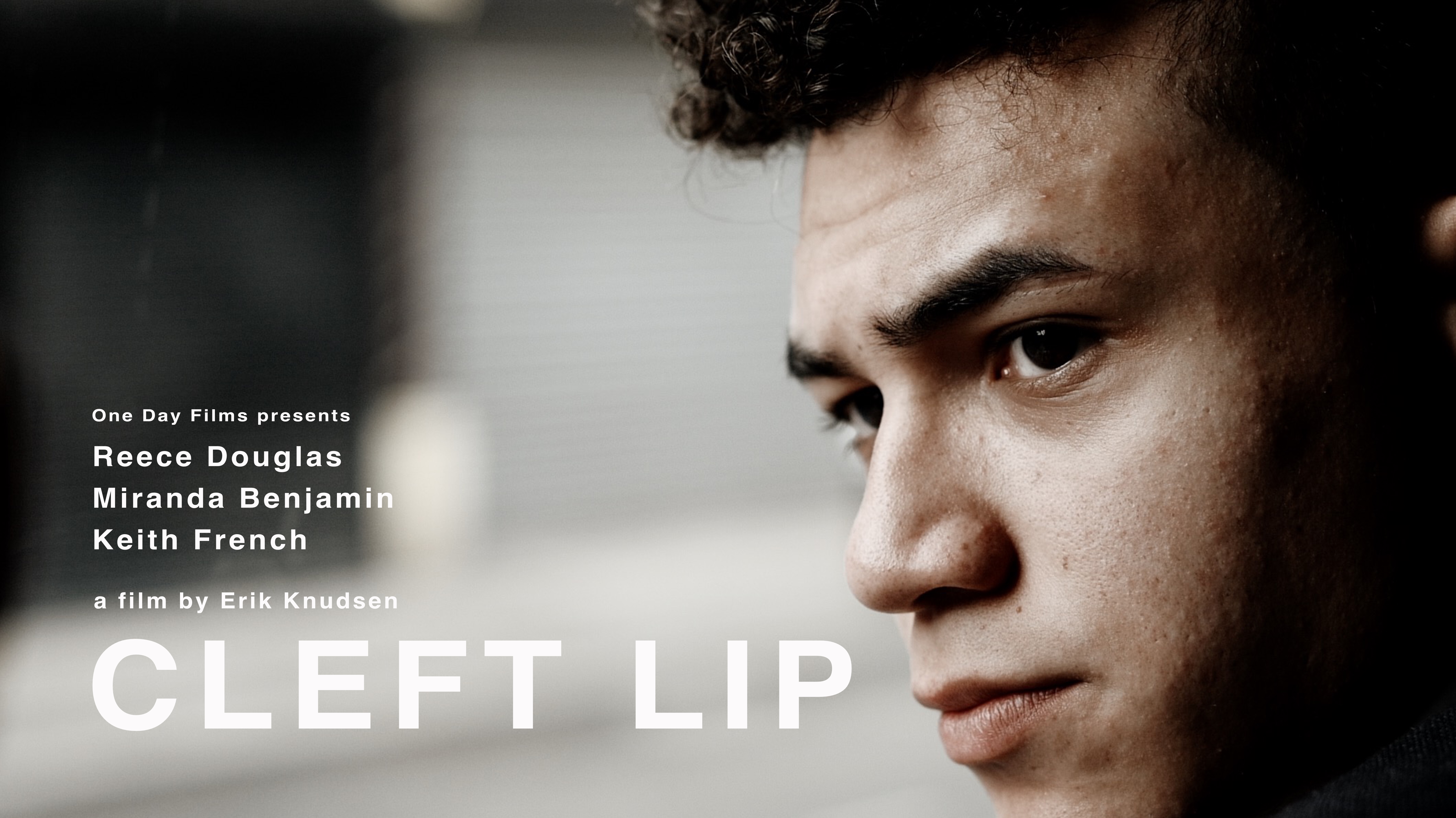 Cleft Lip