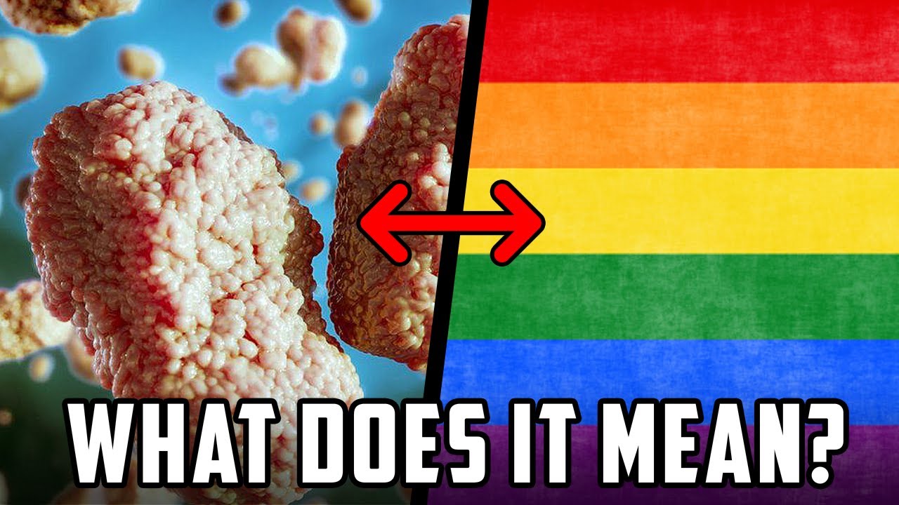 MONKEYPOX SPREADING IN LGBT