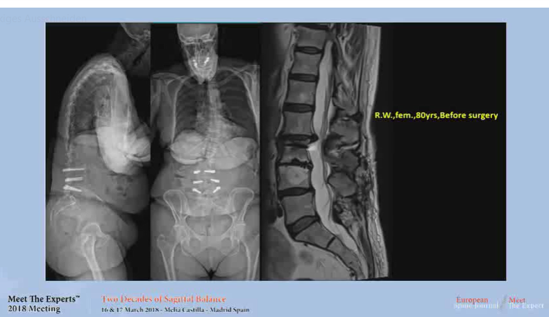 Sagittal balance; case presentation