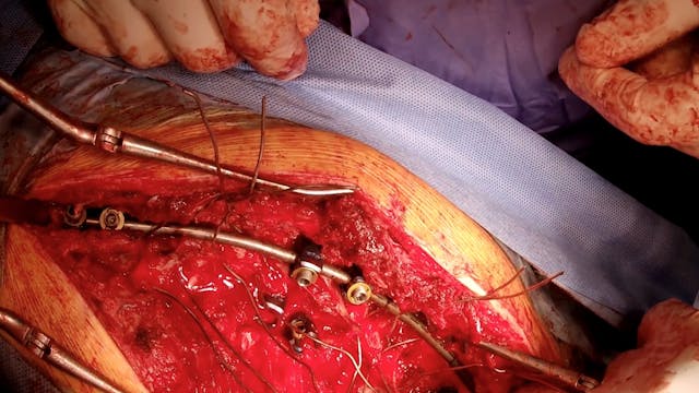 Severe Deformity in Osteogenesis Impe...