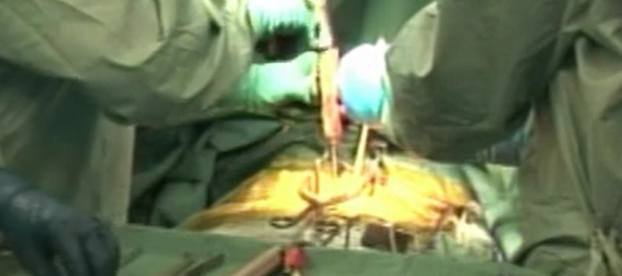 Short segment treatment of adult degenerative scoliosis with TLIF L3-L4