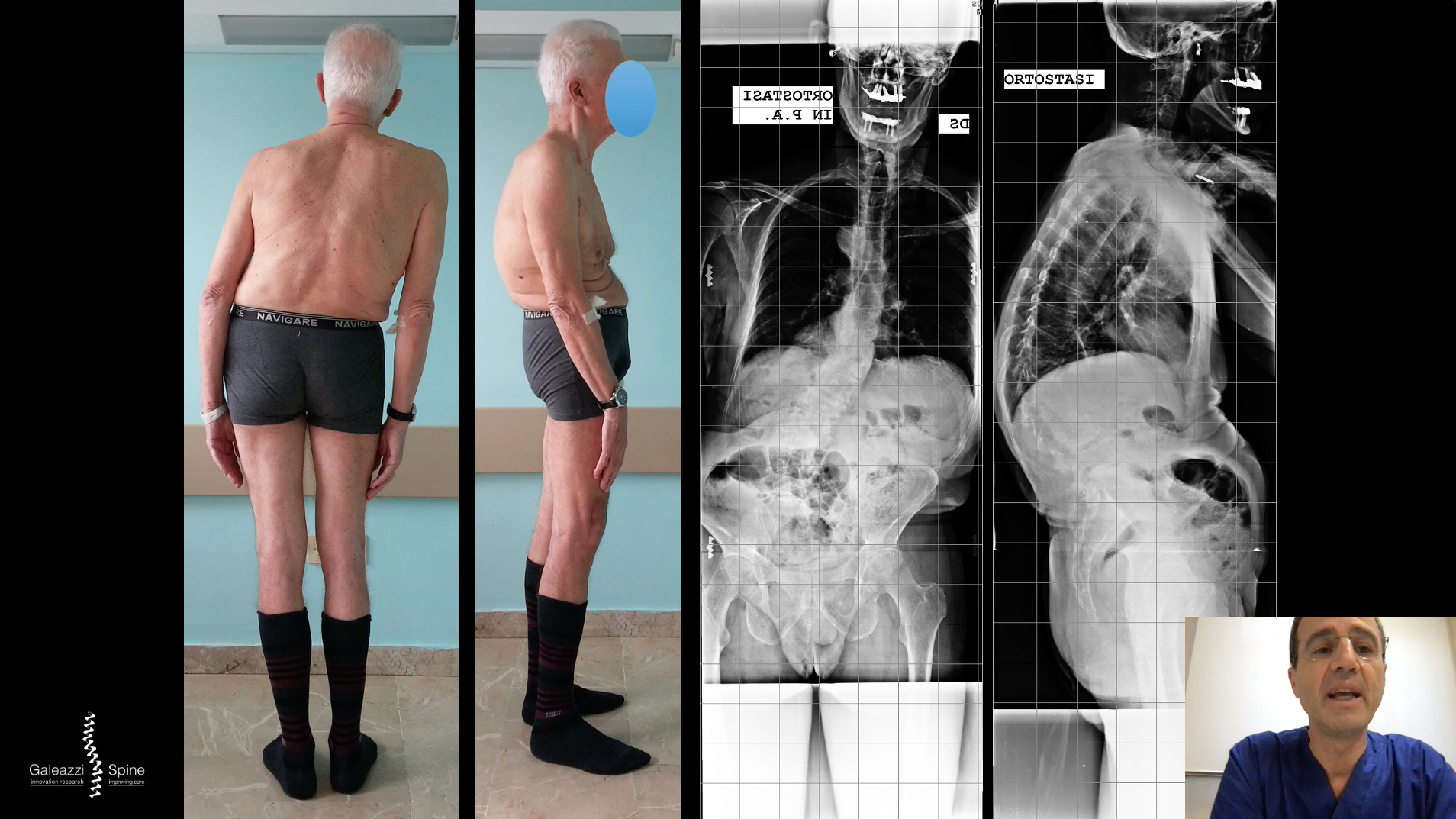 Adult spine deformity -  Where we stand and the road ahead  