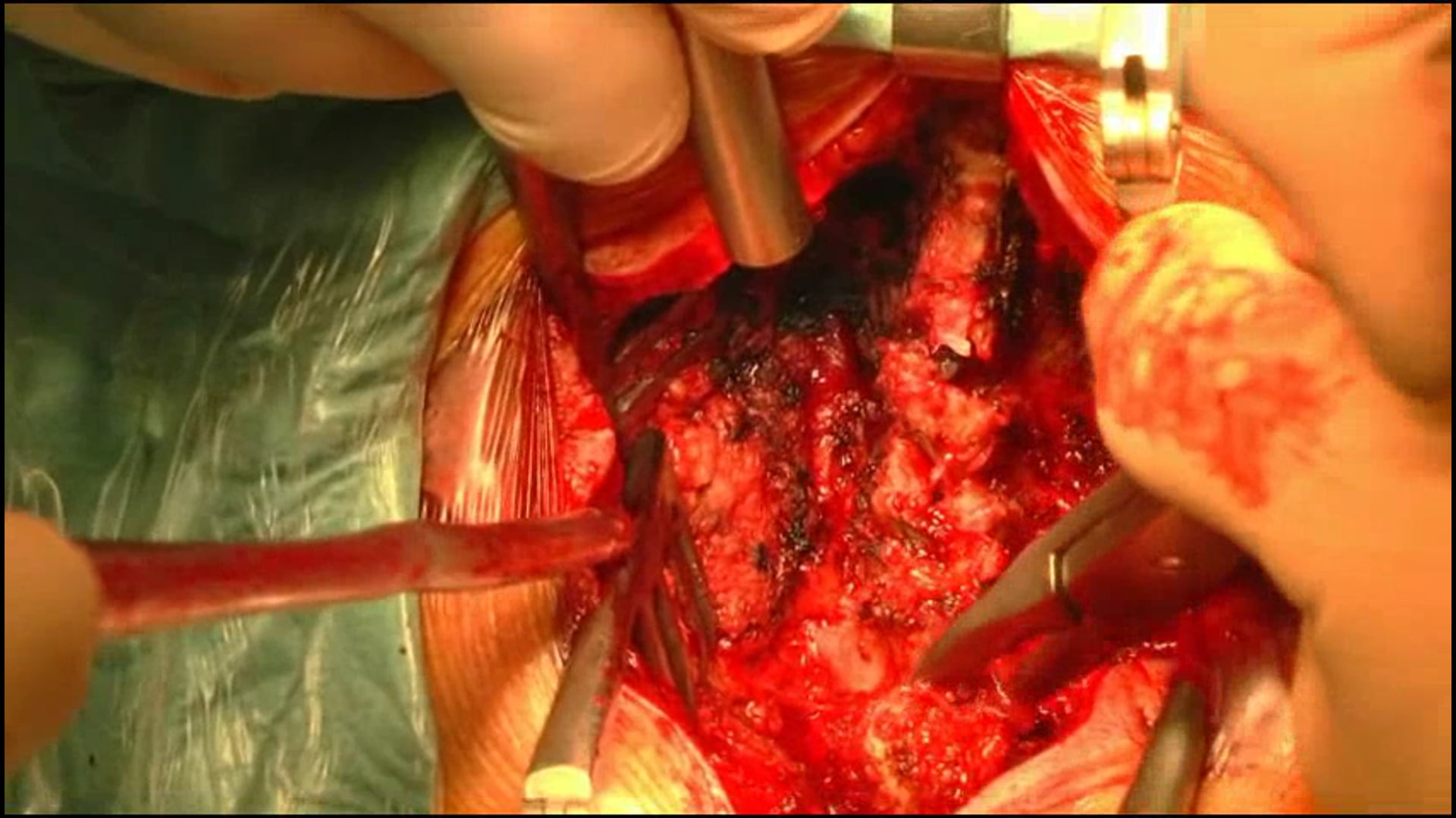 French door laminoplasty for cervical spondylotic myelopathy