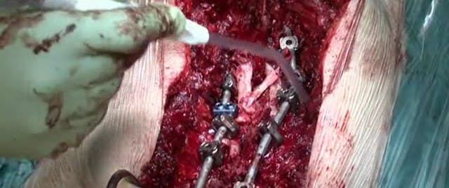 Pedicle subtraction osteotomy in dege...