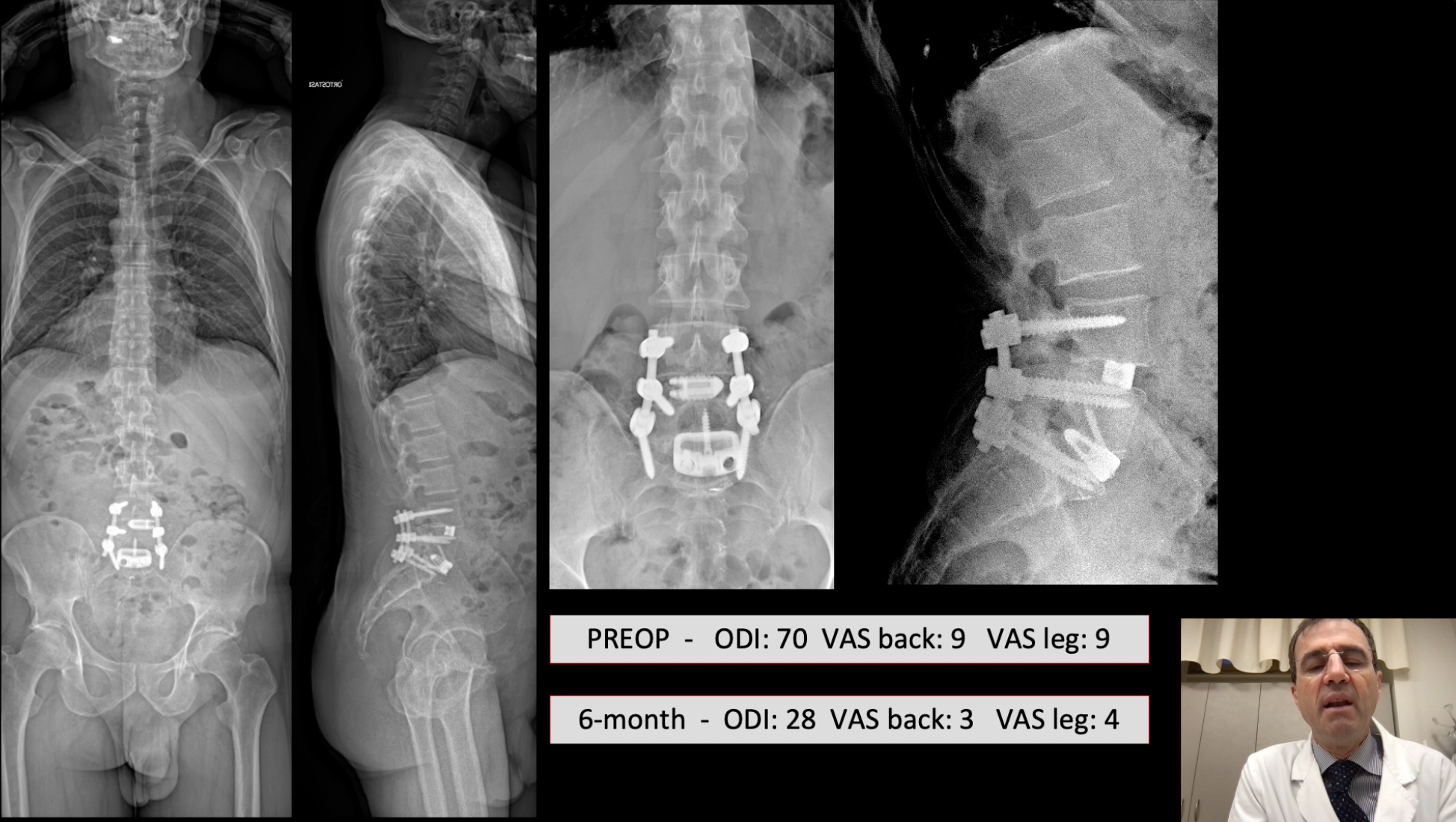 Surgical technique: How to get proper lordosis at L4-L5-S1