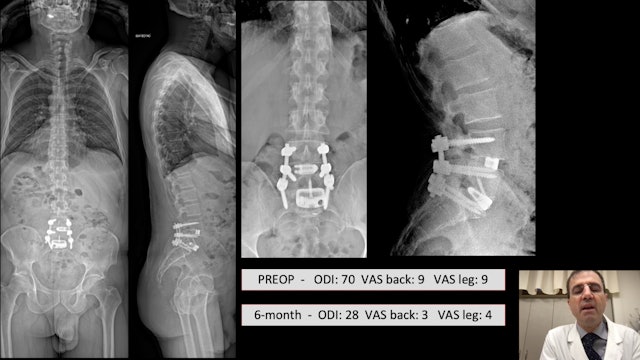 Surgical technique: How to get proper lordosis at L4-L5-S1