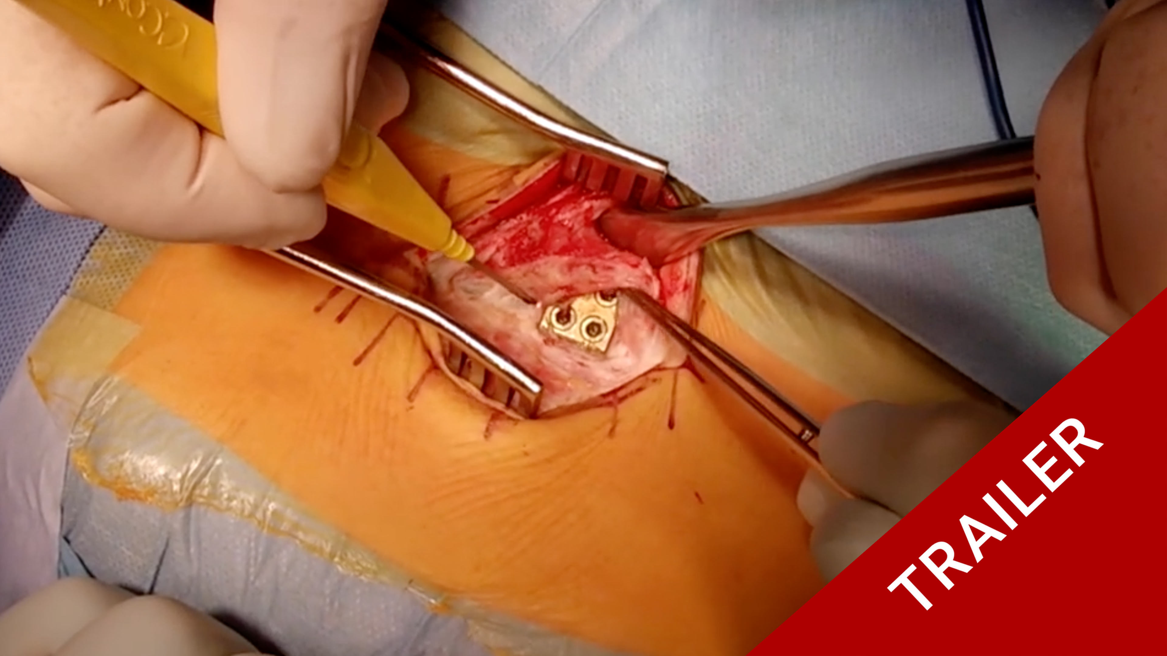 Trailer Growing Rod In Early Onset Scoliosis (EOS)