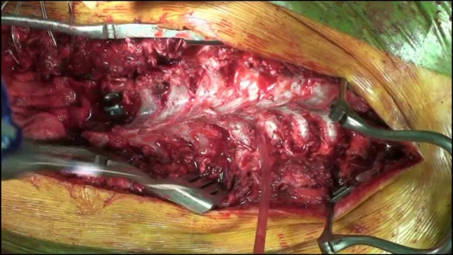 Hybrid strategy for correction and T3 sacrum posterior fusion in a severe ......