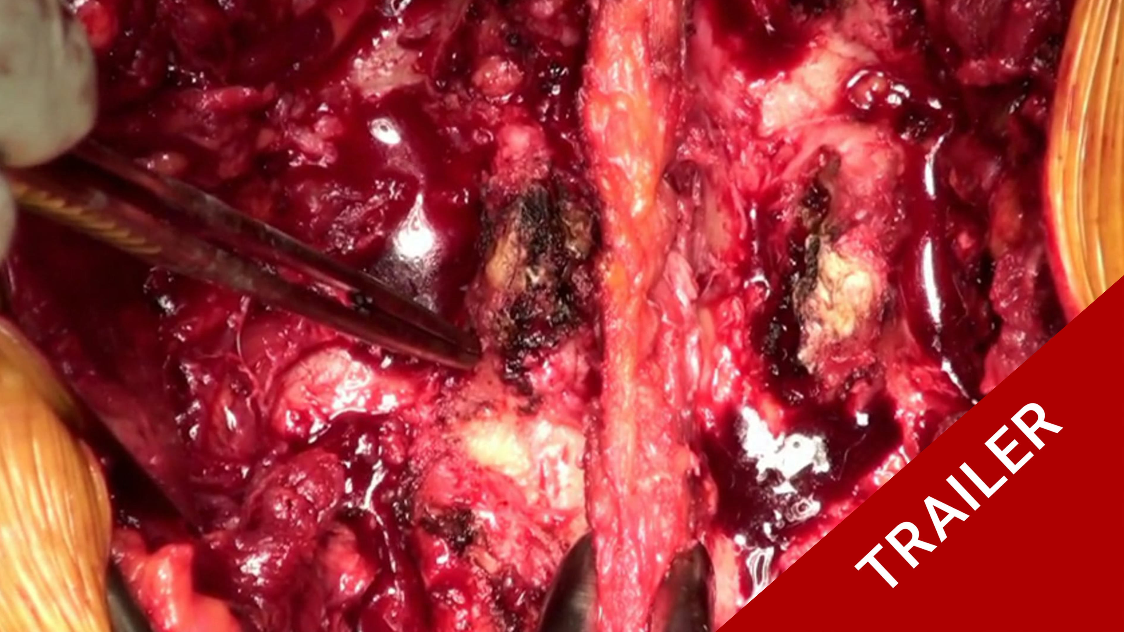 Trailer Transforaminal lumbar interbody fusion