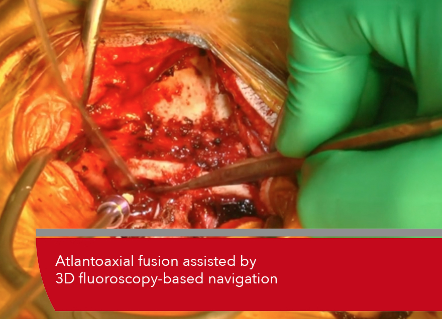Trailer Atlantoaxial fusion assisted by 3D fluoroscopy-based navigation
