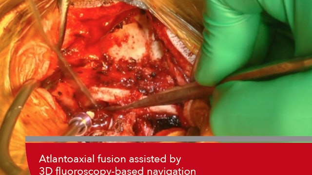 Teaser Atlantoaxial fusion assisted by 3D fluoroscopy-based navigation