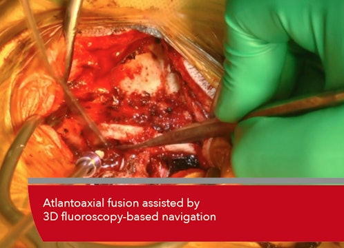 Teaser Atlantoaxial fusion assisted by 3D fluoroscopy-based navigation
