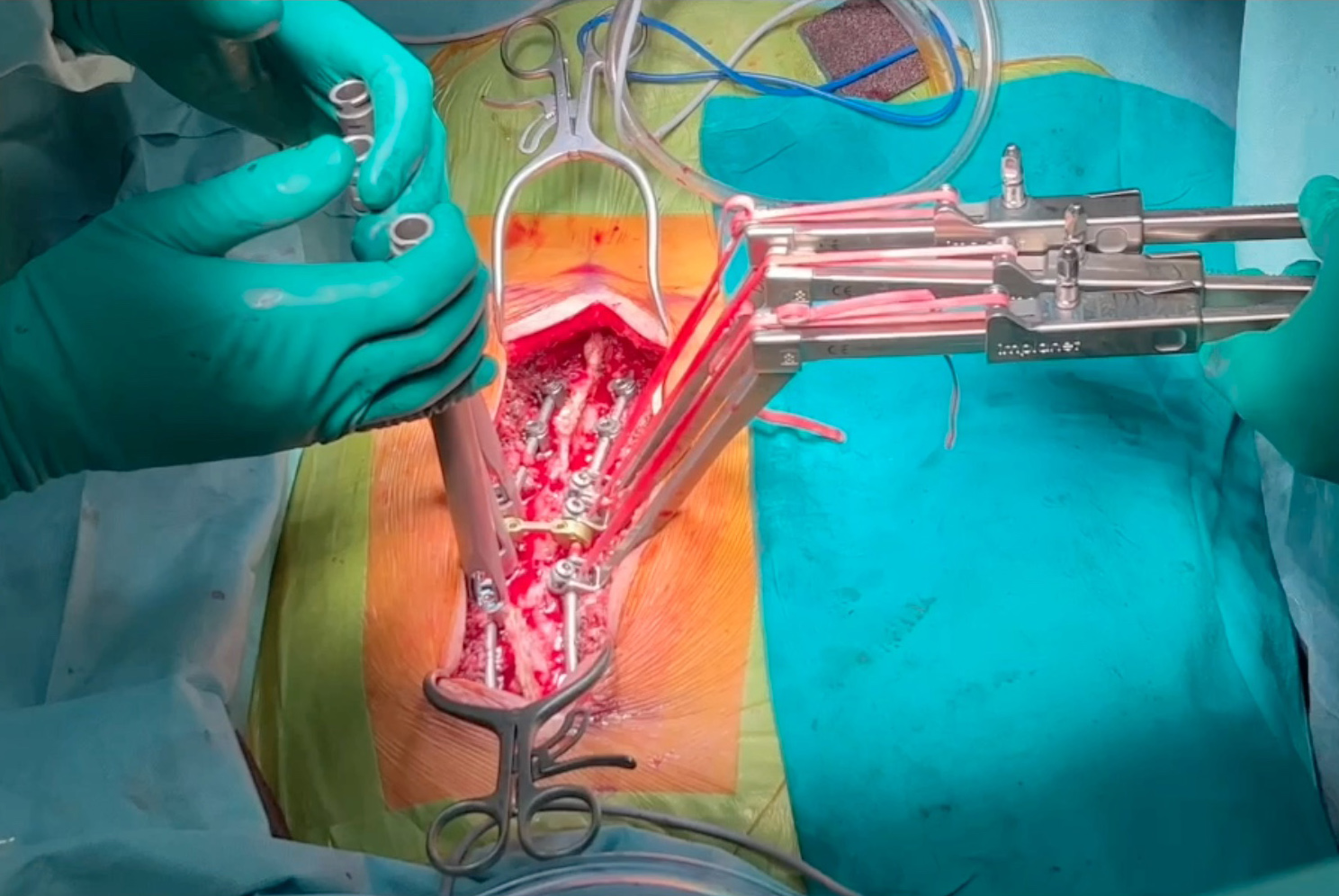 AVDT - Apical Vertebral Derotation and Translation in AIS