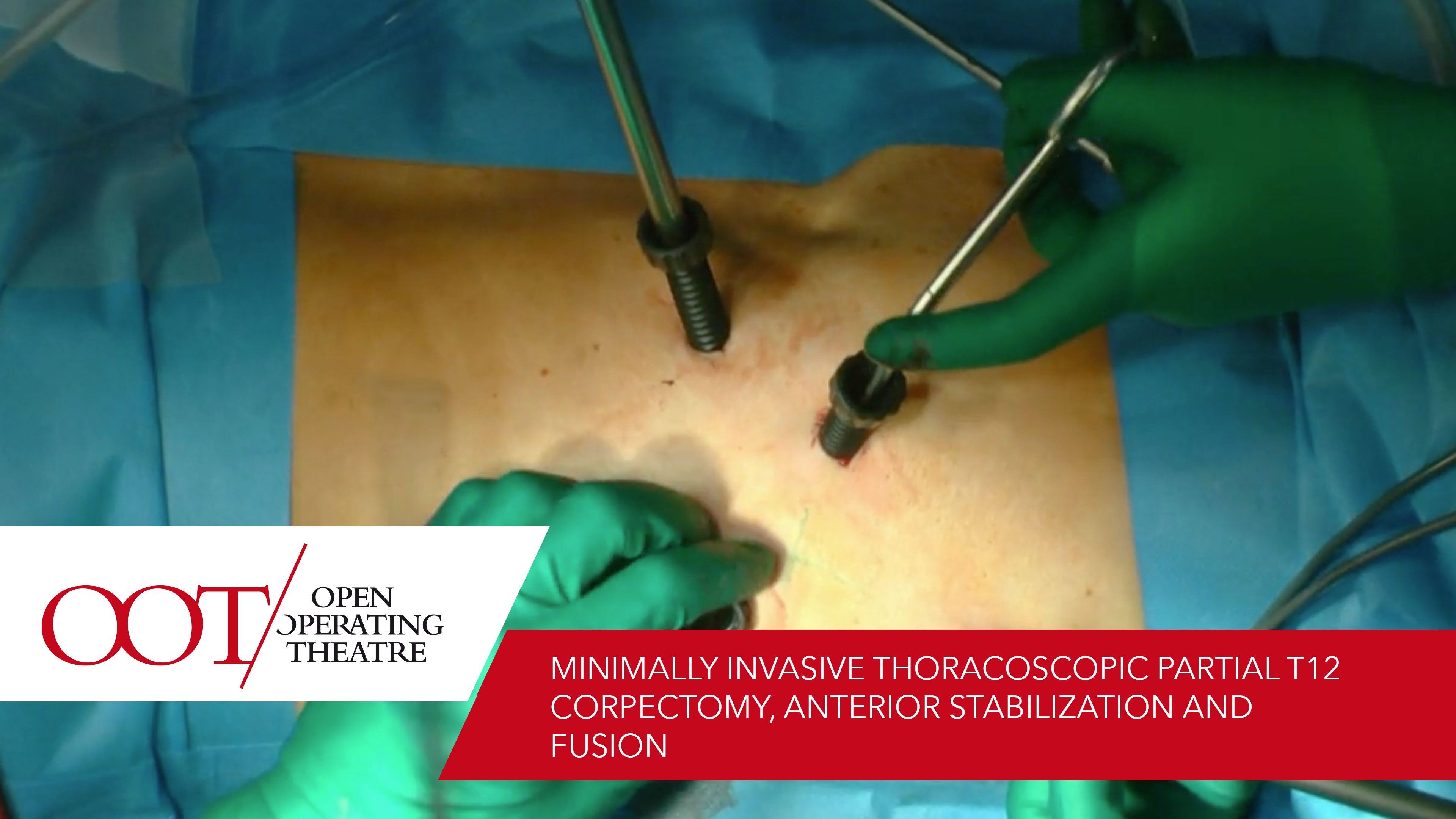 Minimally invasive thoracoscopic partial T12 corpectomy......