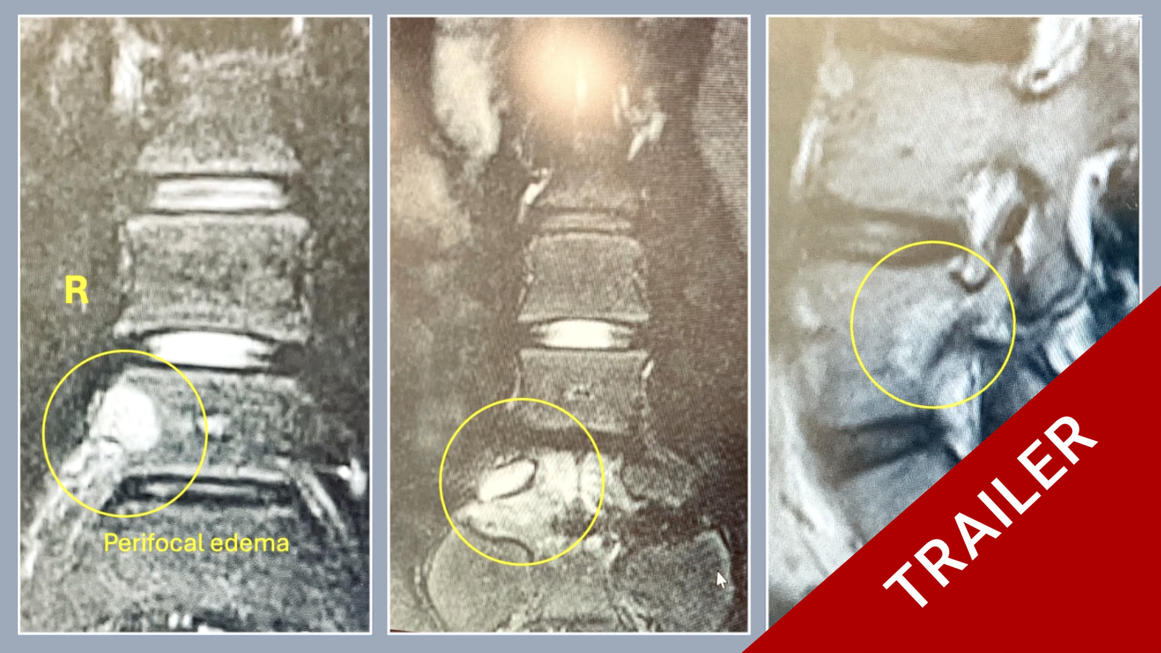 Trailer Osteoid Osteoma of the L5 Vertebra Interarticular portion on the r. side