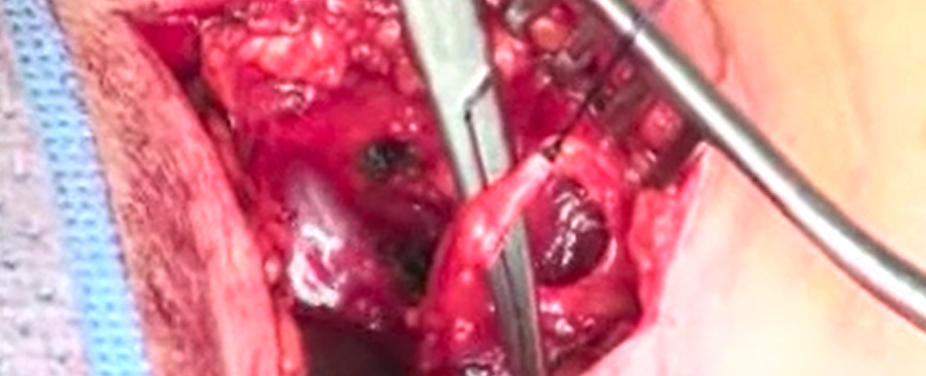 Posterior-anterior resection of a cervical spine osteoblastoma