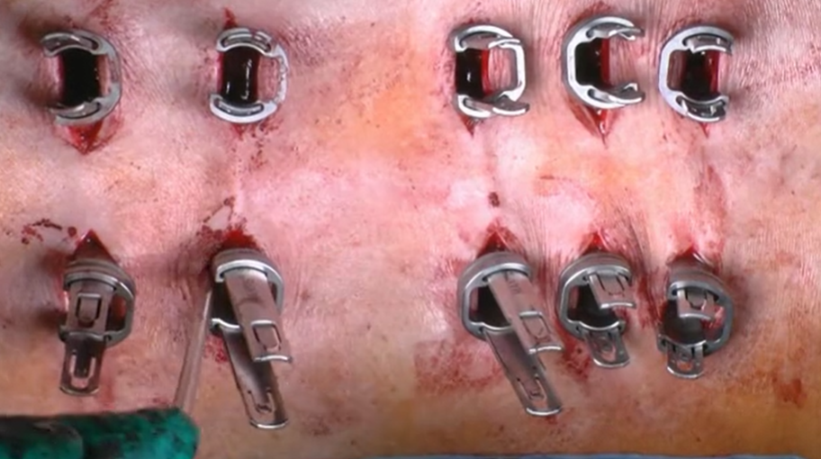 Minimal-invasive revision of adjacent level disease after MIS deformity surgery