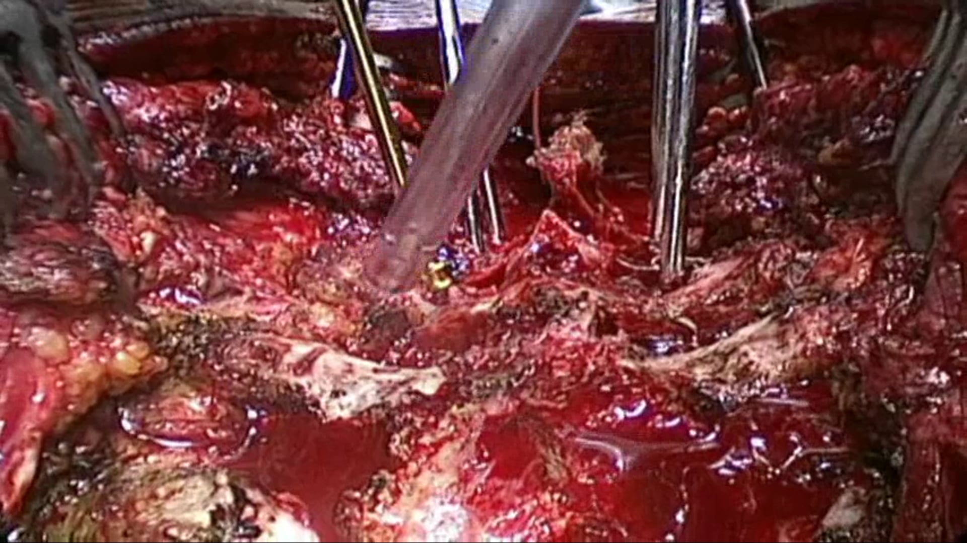 Vertebral column resection for thoracic hyperkyphosis in Pott's disease
