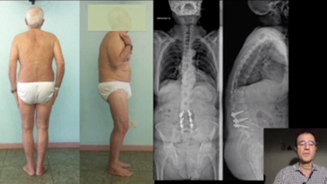 Surgical problems in second operations, adult deformity