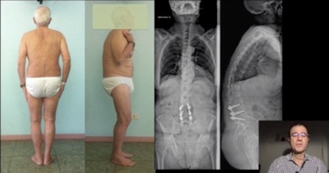 Surgical problems in second operations, adult deformity