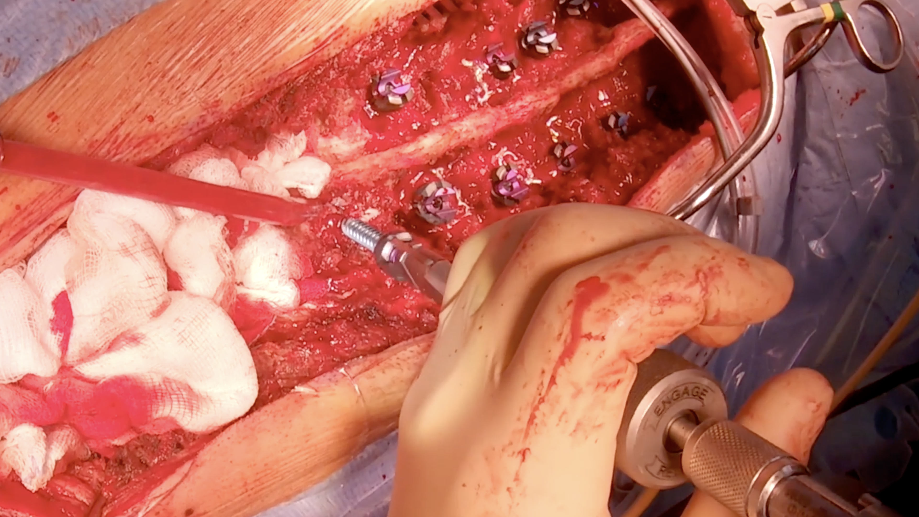 Posterior correction and fusion of a symptomatic idiopathic scoliosis