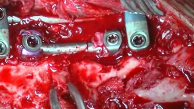 Revision surgery for implant failure after PSO
