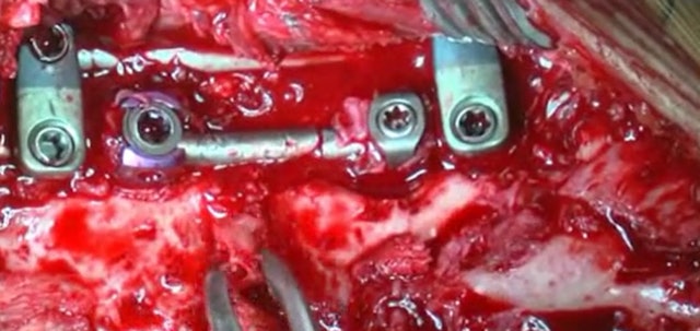 Revision surgery for implant failure after PSO
