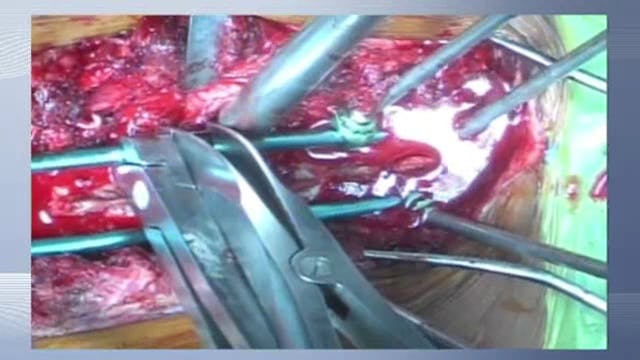 Correction of thoracic kyphosis with ...