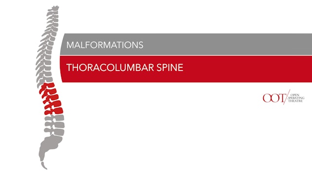 Thoracolumbar spine - Malformations