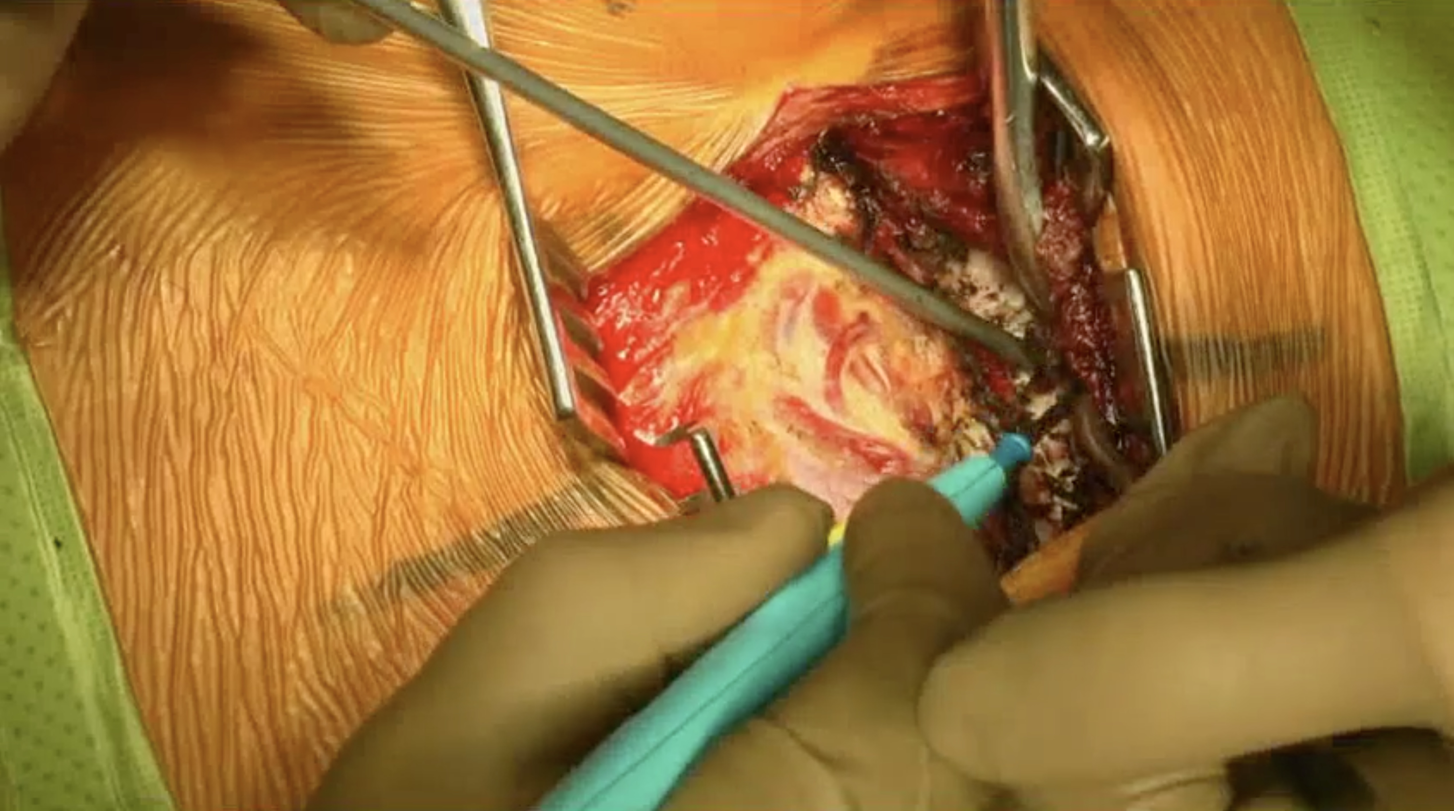 Trailer Circumferential convex growth arrest by posterior approach .......