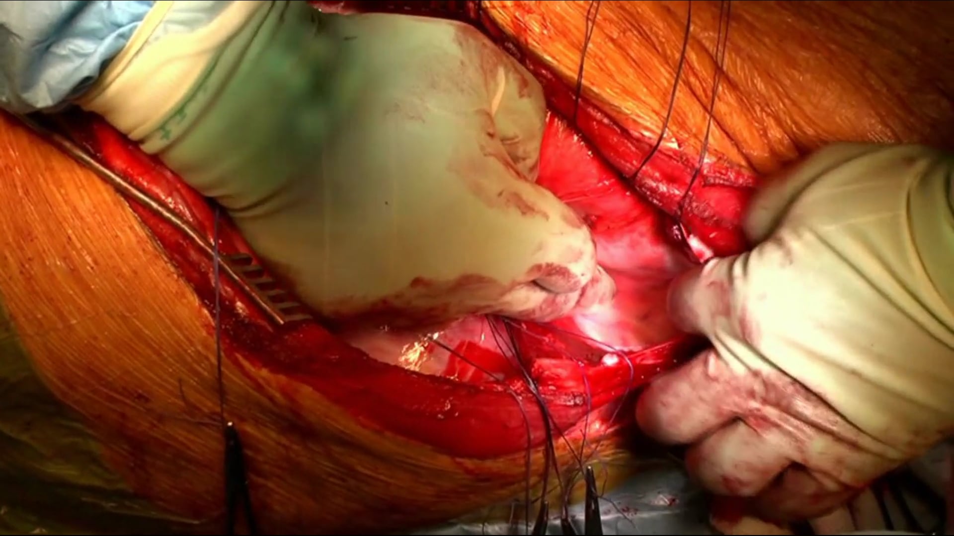 Two stage correction of rigid adolescent idiopathic scoliosis